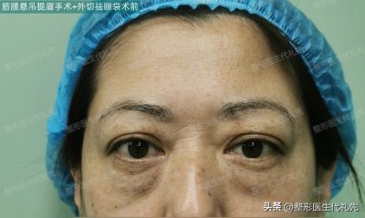 ​55岁女士提眉案例如何做到恢复后“毫无痕迹”，附1-7天对比图